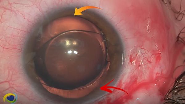 IOL Removal, Phacoemulsification of Subluxated Natural Lens, PCIOL Implantation, and DSAEK thumbnail
