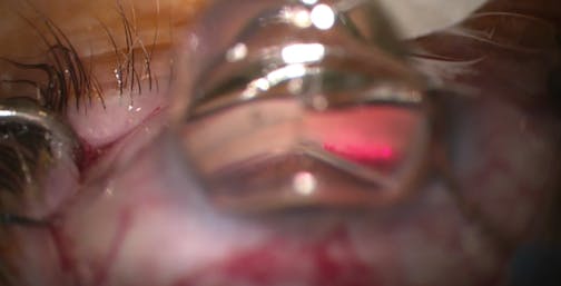 Standalone MIGS: iTrack and iStent Infinite