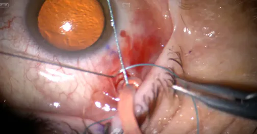 Temporary Scleral Buckling