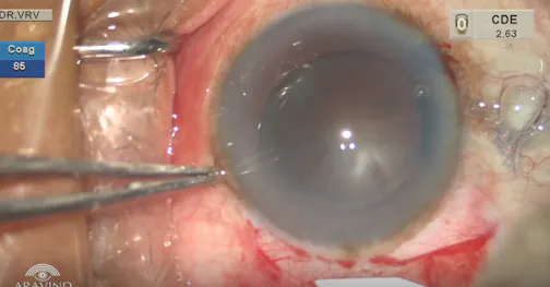 Temporal MSICS in Brown Cataract