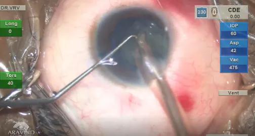 Phacoemulsification in Microcornea With Partial Iris Coloboma