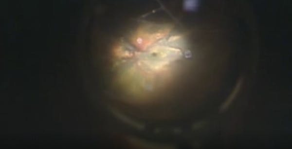 Management of Suprachoroidal Hemorrhage in Aphakic Glaucoma thumbnail