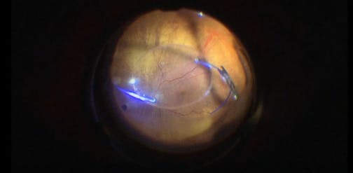 Subluxated IOL Rescue With Sutureless Scleral Fixation