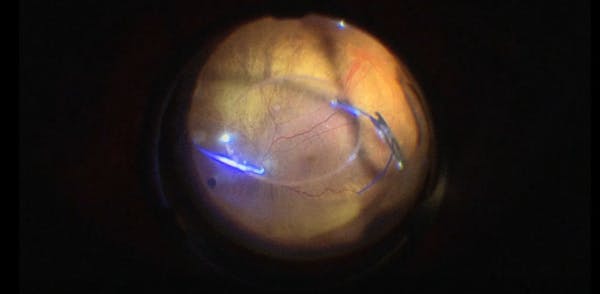 Subluxated IOL Rescue With Sutureless Scleral Fixation thumbnail
