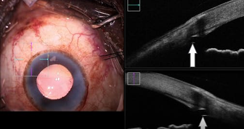 Hydrus Microstent Scaffolding