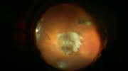 Hard Dislocated Cataract Fragmentation and Soleko Carlevale IOL Implantation