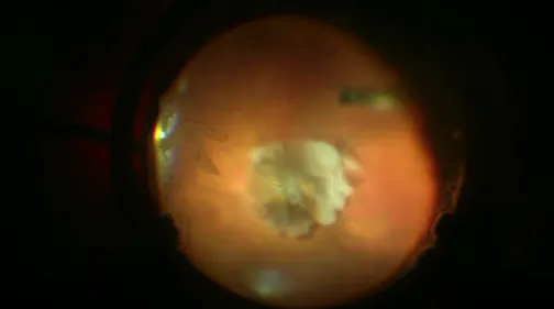 Hard Dislocated Cataract Fragmentation and Soleko Carlevale IOL Implantation