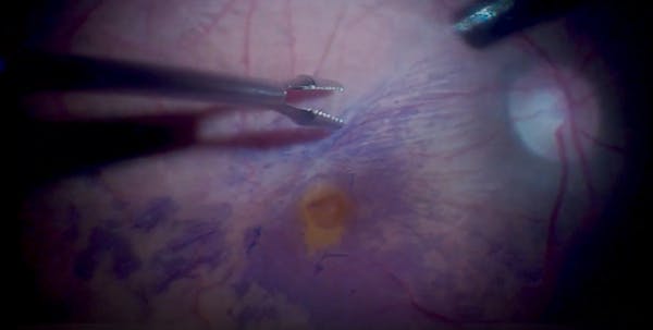 Optimal Timing for ERM Surgery in Patients With Pseudo-Macular Holes thumbnail