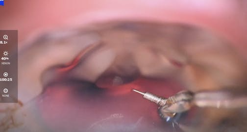 Interventional Glaucoma Case: iDose and iStent Infinite