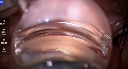 Canaloplasty and Stenting: Flush the System From the Trabecular Meshwork to the Venous System