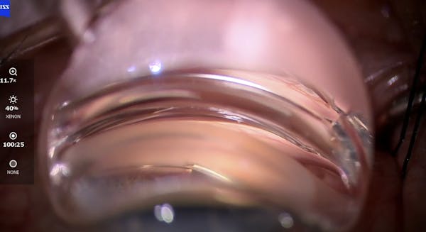 Canaloplasty and Stenting: Flush the System From the Trabecular Meshwork to the Venous System thumbnail