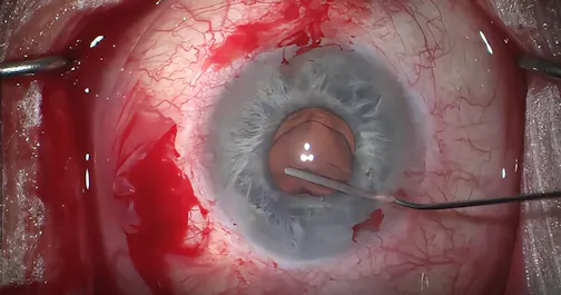 Subluxated PCIOL:  Gore-Tex Followed by Yamane