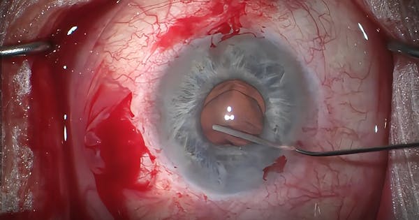 Subluxated PCIOL:  Gore-Tex Followed by Yamane thumbnail
