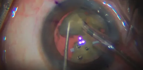 Phacoemulsification in a Capsular Fibrosis