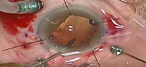 Scleral IOL Fixation in a Small Pupil With Iris Hooks - Eyetube