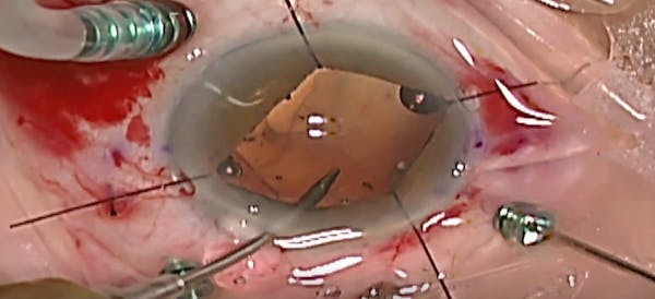 Small Pupil Scleral Fixation of IOL With Iris Hooks thumbnail