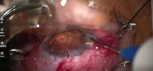 iTrack Canaloplasty After Durysta