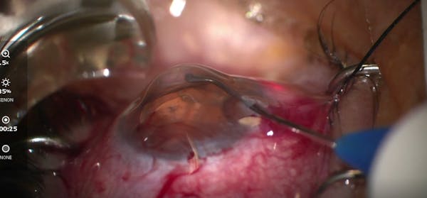 iTrack Canaloplasty After Durysta thumbnail