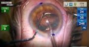 Cataract Surgery at Physiologic IOP: Harnessing the Powers of Active Fluidics