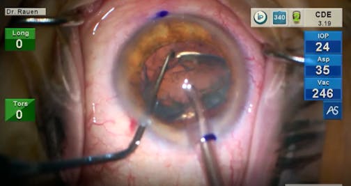 Cataract Surgery at Physiologic IOP: Harnessing the Powers of Active Fluidics