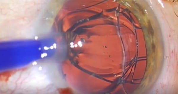1stQ AddOn for Pseudophakic Eyes thumbnail