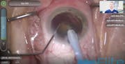 Effective Phaco Time vs Cumulative Dissipated Energy