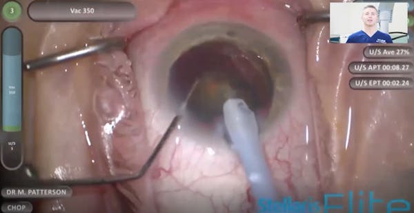 Effective Phaco Time vs Cumulative Dissipated Energy thumbnail