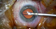 Malyugin Ring 7.0 Surgical Technique