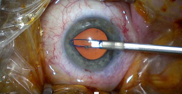 Malyugin Ring 7.0 Surgical Technique thumbnail