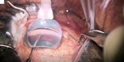 Microscope Integrated Gonioscopy System for MIGS