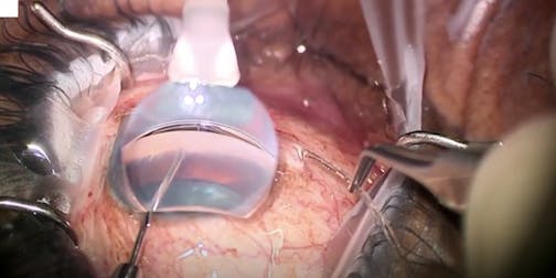 Microscope Integrated Gonioscopy System for MIGS