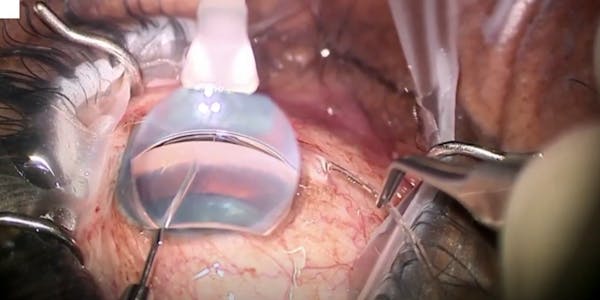 Microscope Integrated Gonioscopy System for MIGS thumbnail