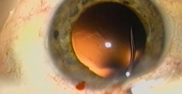 Osher MaxField 78D in the OR thumbnail