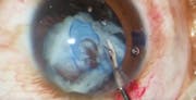 VisionBlue for Complex Cataract Surgery