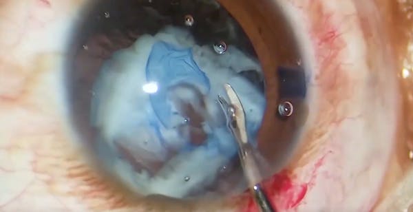 VisionBlue for Complex Cataract Surgery thumbnail