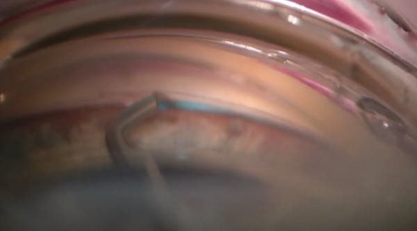 Implant-Free MIGS and SION thumbnail