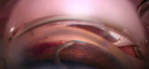 Light Adjustable Lens and OMNI Surgical System