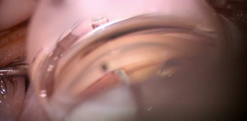 Kahook Dual Blade for Steroid-Induced Glaucoma