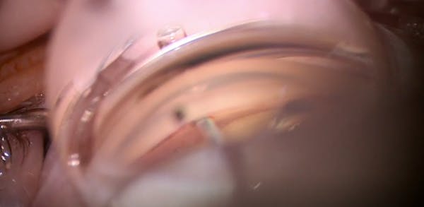Kahook Dual Blade for Steroid-Induced Glaucoma thumbnail