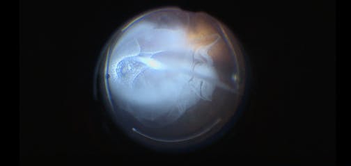 Posterior Vitreous Detachment With Vitreomacular Traction