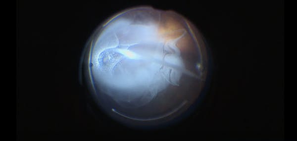 Posterior Vitreous Detachment With Vitreomacular Traction thumbnail