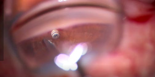 Interventional Glaucoma With iDose