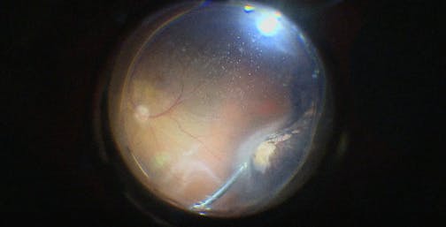 Pseudophakic Retinal Detachment Repair Without PFCL