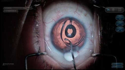 IC-8 Pinhole Lens in a Post-PKP Patient