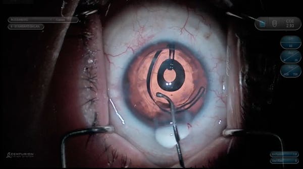 IC-8 Pinhole Lens in a Post-PKP Patient thumbnail