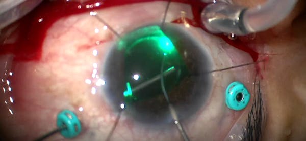 Usage of Endolaser-Assisted Treatment thumbnail