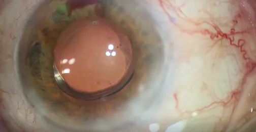 Inferior Hydrus and a Toric IOL Surprise