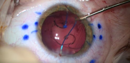 Capsular Tension Segment Fixation of IOL-Bag Complex for Pediatric Lens Coloboma and Nanophthalmos