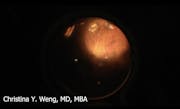 Surgery for Vitreous Opacities in an Eye With MFIOL (Narrated Case)