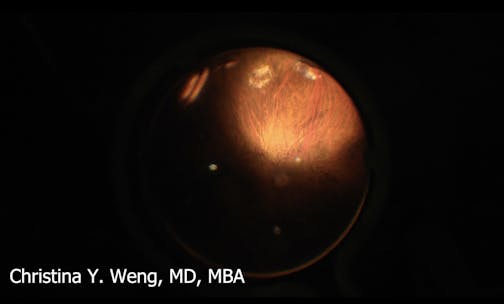 Surgery for Vitreous Opacities in an Eye With MFIOL (Narrated Case)